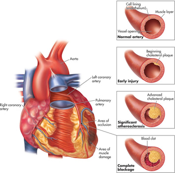 Jantung koroner merupakan salah satu gangguan peredaran darah manusia yang terjadi karena penyumbatan arteri koroner oleh